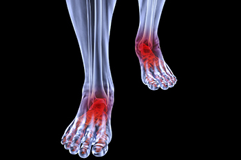 Arthritic foot and ankle care treatment, foot arthritis treatment in the Clark County, NV: Las Vegas (Paradise, Summerlin South, Spring Valley, Enterprise, Winchester, Sunrise Manor, Sloan, Blue Diamond, Henderson) areas